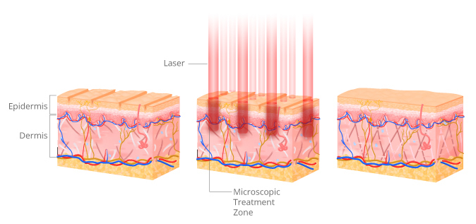 Renas (1550 нм) – фракционный эрбиевый лазер для омоложения и лечения рубцов фото 5