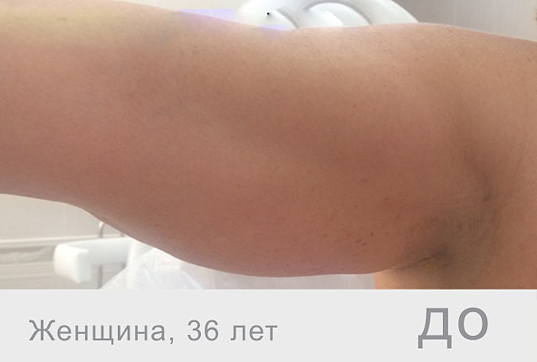 Lift, 10мл. (Франция) фото 2